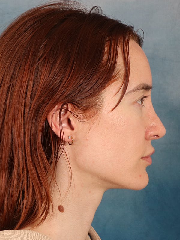 Rhinoplasty Before & After Gallery - Patient 363135 - Image 10