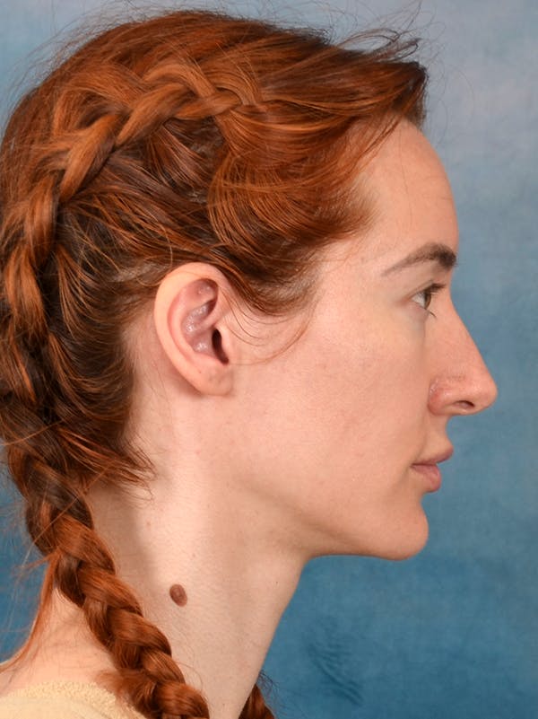 Rhinoplasty Before & After Gallery - Patient 363135 - Image 9