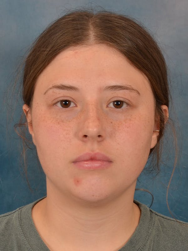 Rhinoplasty Before & After Gallery - Patient 279409 - Image 5