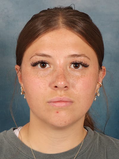 Rhinoplasty Before & After Gallery - Patient 279409 - Image 6