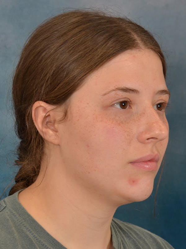 Rhinoplasty Before & After Gallery - Patient 279409 - Image 7