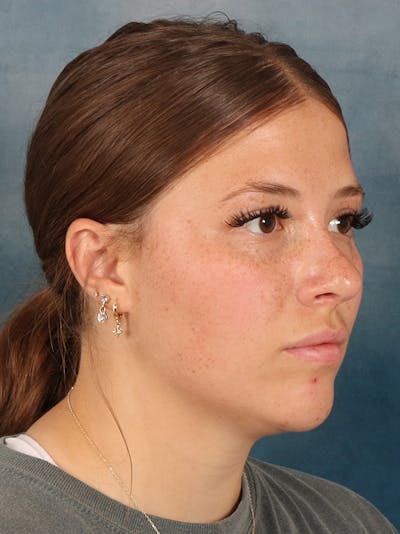 Rhinoplasty Before & After Gallery - Patient 279409 - Image 8