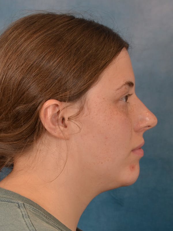 Rhinoplasty Before & After Gallery - Patient 279409 - Image 9