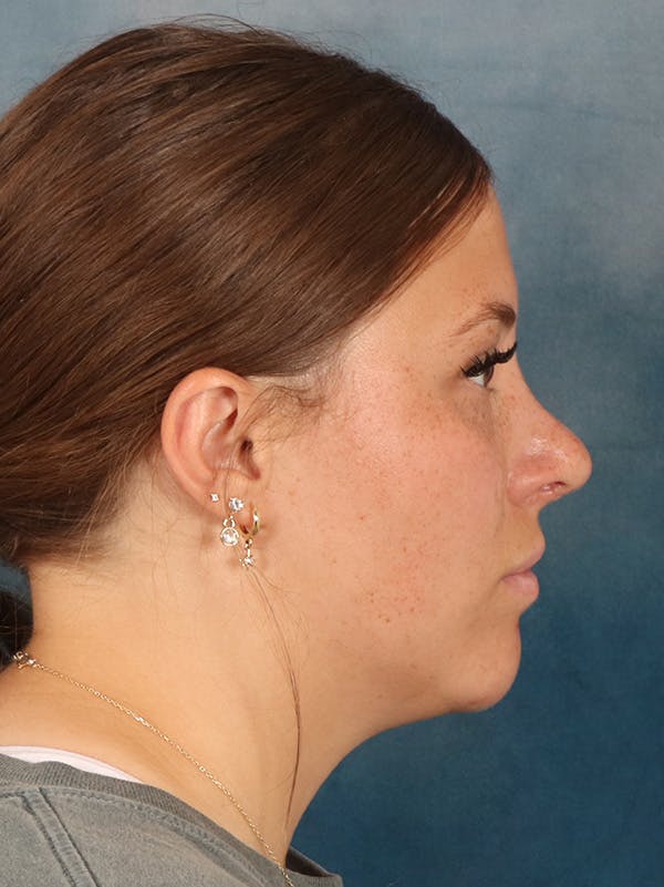 Rhinoplasty Before & After Gallery - Patient 279409 - Image 10