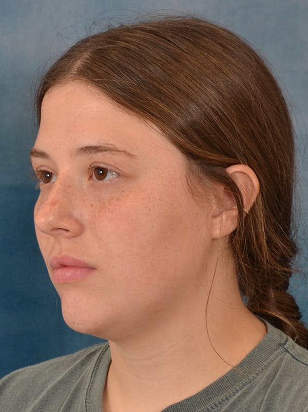 Rhinoplasty Before & After Gallery - Patient 279409 - Image 3
