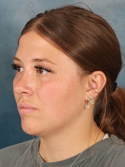 Rhinoplasty Before & After Gallery - Patient 279409 - Image 4