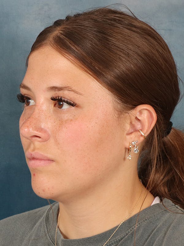 Rhinoplasty Before & After Gallery - Patient 279409 - Image 4