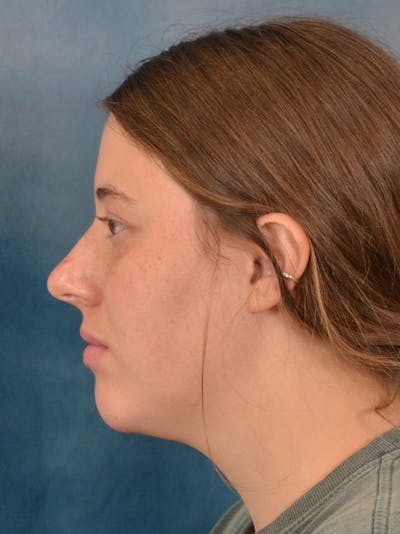 Rhinoplasty Before & After Gallery - Patient 61874293 - Image 1