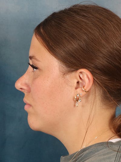 Rhinoplasty Before & After Gallery - Patient 61874293 - Image 2