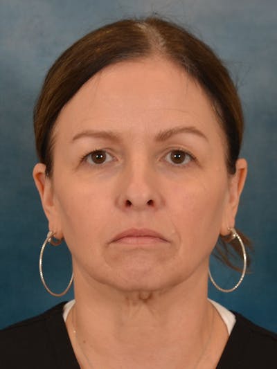 Deep Neck Lift Before & After Gallery - Patient 330463 - Image 1