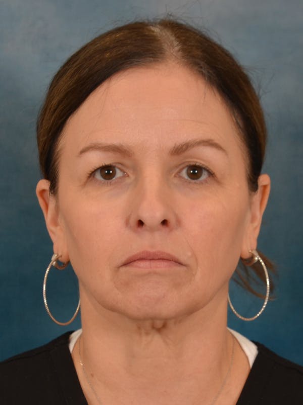 Deep Neck Lift Before & After Gallery - Patient 330463 - Image 1