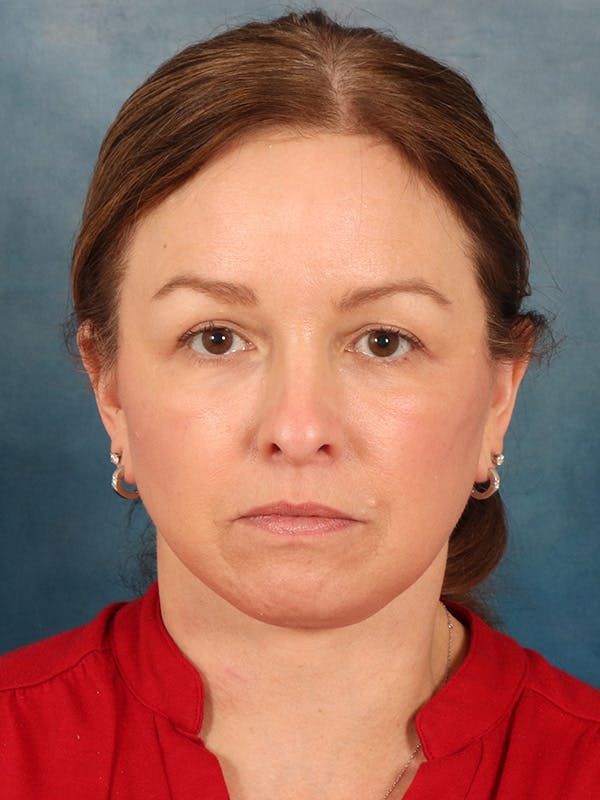 Deep Neck Lift Before & After Gallery - Patient 330463 - Image 2