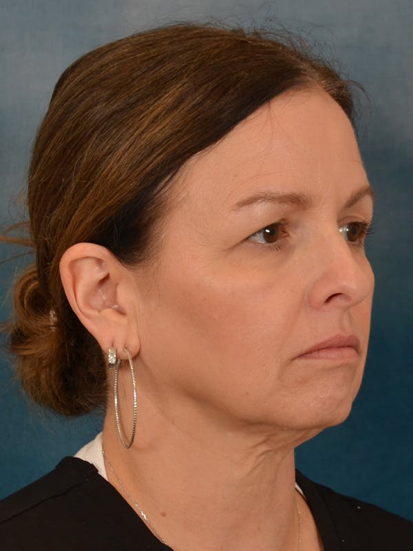 Deep Neck Lift Before & After Gallery - Patient 330463 - Image 7