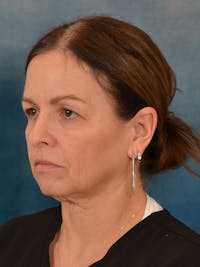 Deep Plane Facelift Before & After Gallery - Patient 148969 - Image 1