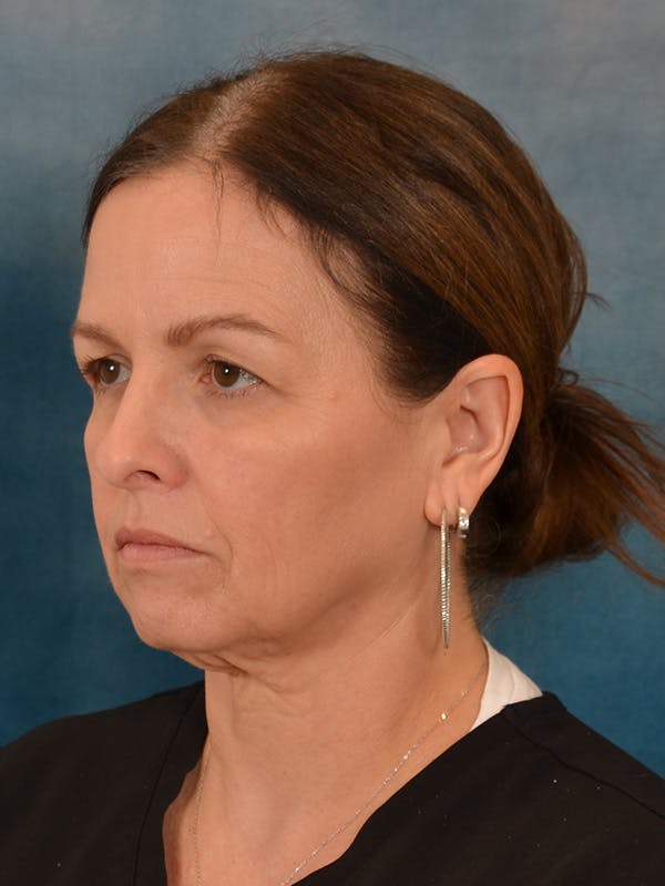 Deep Neck Lift Before & After Gallery - Patient 330463 - Image 3