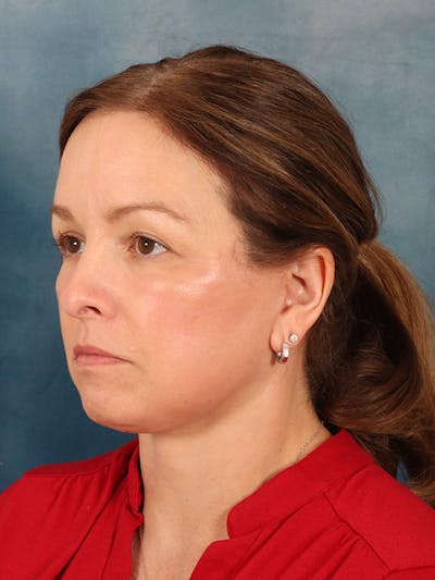 Deep Neck Lift Before & After Gallery - Patient 330463 - Image 4