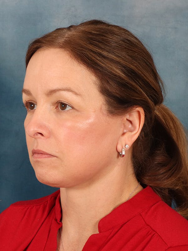 Deep Neck Lift Before & After Gallery - Patient 330463 - Image 4