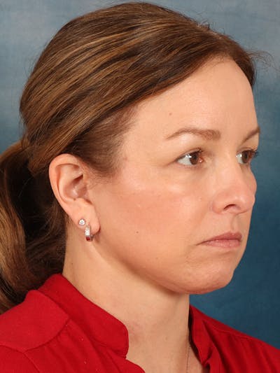 Deep Neck Lift Before & After Gallery - Patient 330463 - Image 8