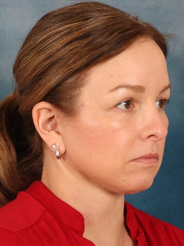 Deep Neck Lift Before & After Gallery - Patient 330463 - Image 8