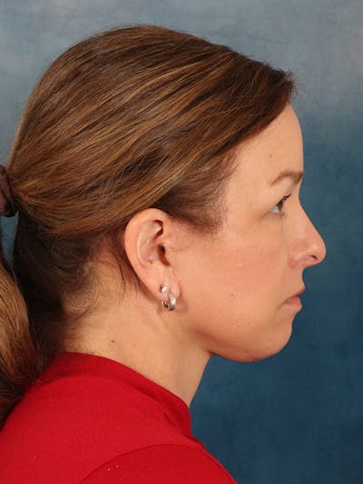 Deep Neck Lift Before & After Gallery - Patient 330463 - Image 10