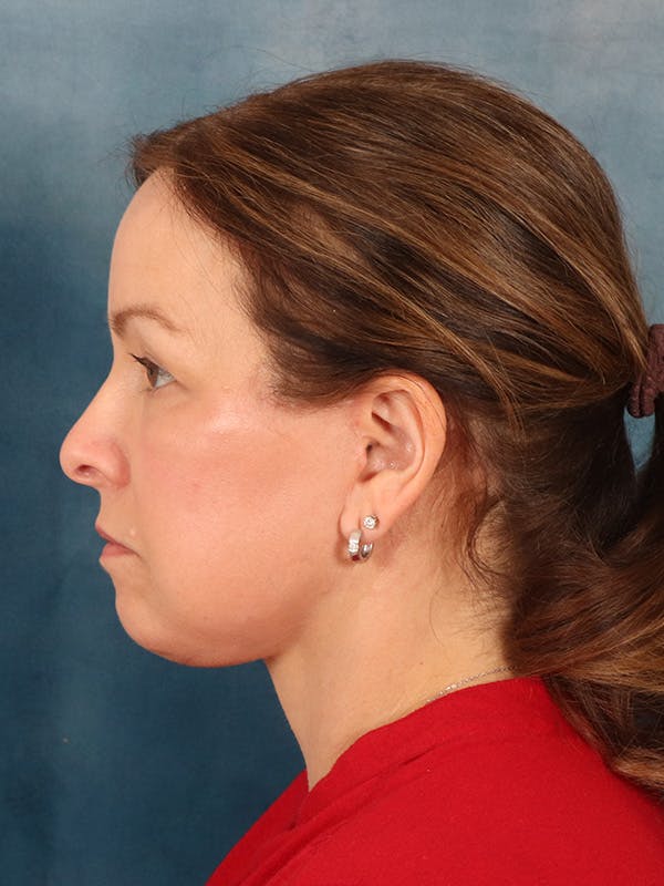 Deep Neck Lift Before & After Gallery - Patient 330463 - Image 6