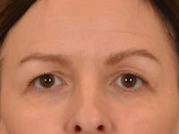 Eyelid Lift Before & After Gallery - Patient 232550 - Image 1
