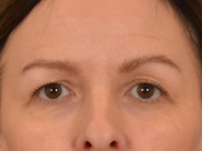 Eyelid Lift Before & After Gallery - Patient 232550 - Image 1