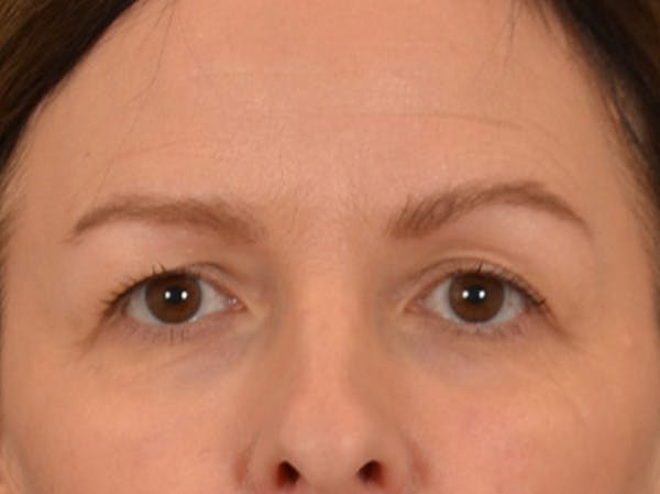 Eyelid Lift Before & After Gallery - Patient 232550 - Image 1