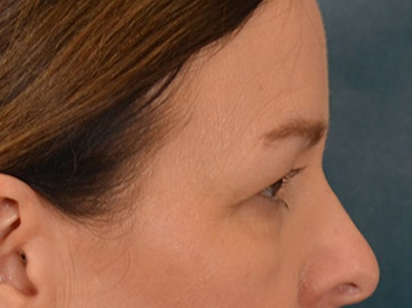 Eyelid Lift Before & After Gallery - Patient 232550 - Image 5