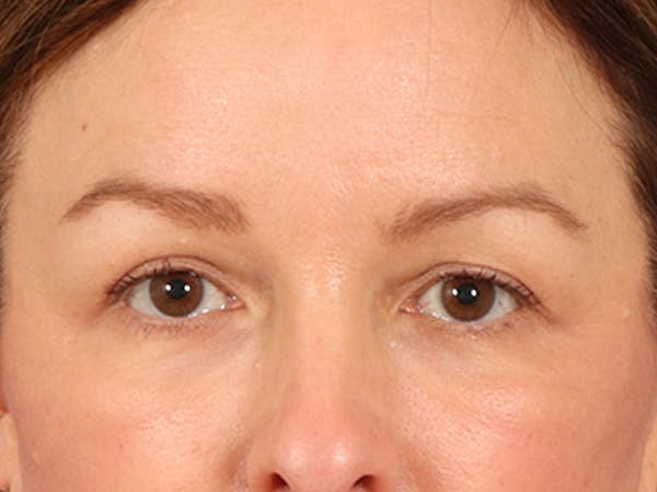 Eyelid Lift Before & After Gallery - Patient 232550 - Image 2