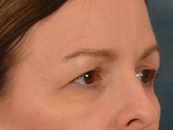 Eyelid Lift Before & After Gallery - Patient 232550 - Image 3
