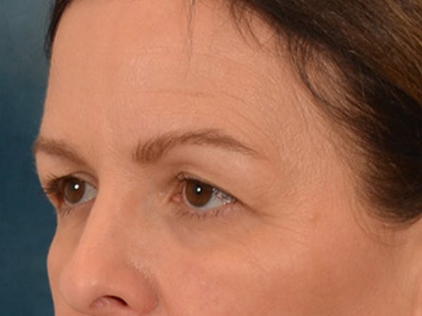 Eyelid Lift Before & After Gallery - Patient 232550 - Image 7