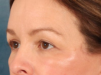 Eyelid Lift Before & After Gallery - Patient 232550 - Image 8