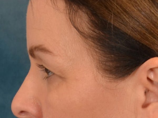 Eyelid Lift Before & After Gallery - Patient 232550 - Image 9