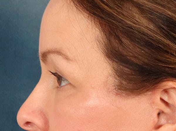 Eyelid Lift Before & After Gallery - Patient 232550 - Image 10