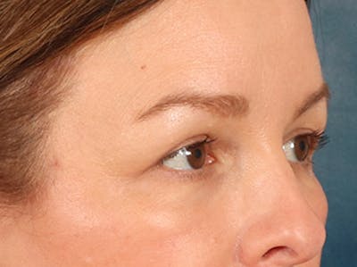 Eyelid Lift Before & After Gallery - Patient 232550 - Image 4