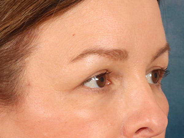 Eyelid Lift Before & After Gallery - Patient 232550 - Image 4