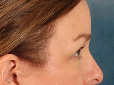 Eyelid Lift Before & After Gallery - Patient 232550 - Image 6