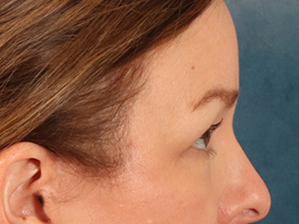 Eyelid Lift Before & After Gallery - Patient 232550 - Image 6