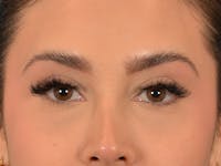 Eyelid Lift Before & After Gallery - Patient 415954 - Image 1