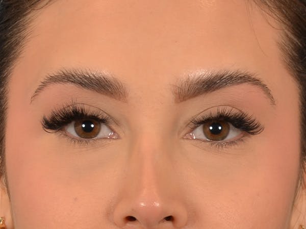Eyelid Lift Before & After Gallery - Patient 415954 - Image 1