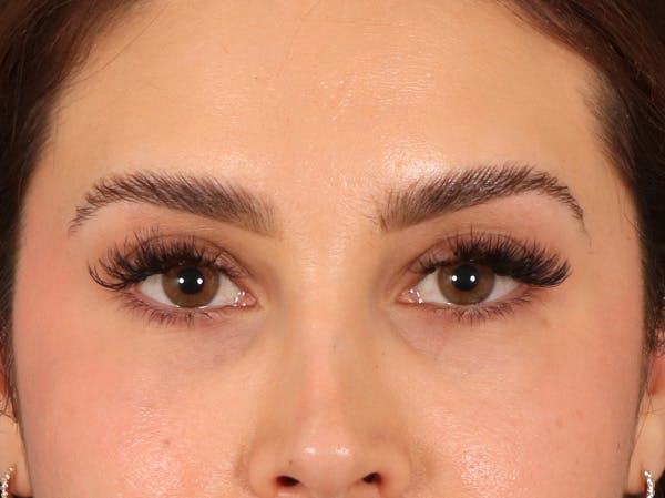 Eyelid Lift Before & After Gallery - Patient 415954 - Image 2