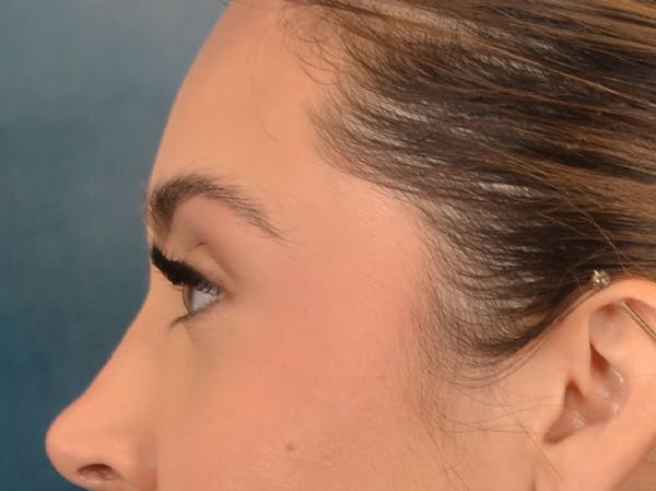 Eyelid Lift Before & After Gallery - Patient 415954 - Image 9