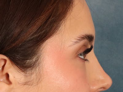 Eyelid Lift Before & After Gallery - Patient 415954 - Image 6