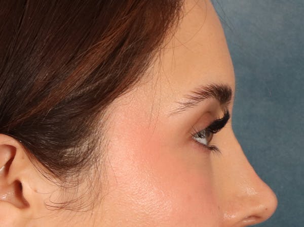 Eyelid Lift Before & After Gallery - Patient 415954 - Image 6