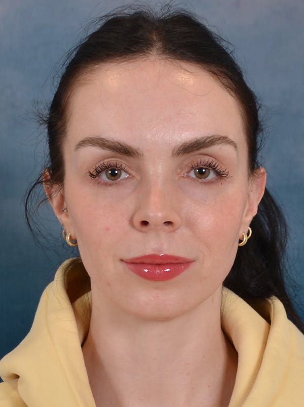 Rhinoplasty Before & After Gallery - Patient 61874293 - Image 5