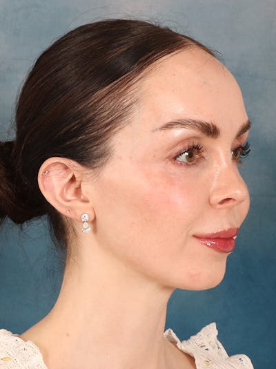 Rhinoplasty Before & After Gallery - Patient 61874293 - Image 8