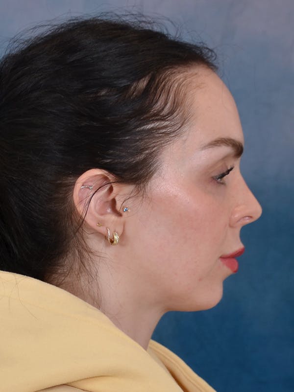 Rhinoplasty Before & After Gallery - Patient 61874293 - Image 9