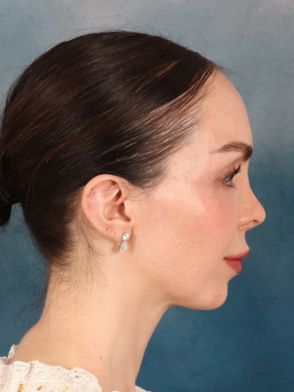 Rhinoplasty Before & After Gallery - Patient 61874293 - Image 10