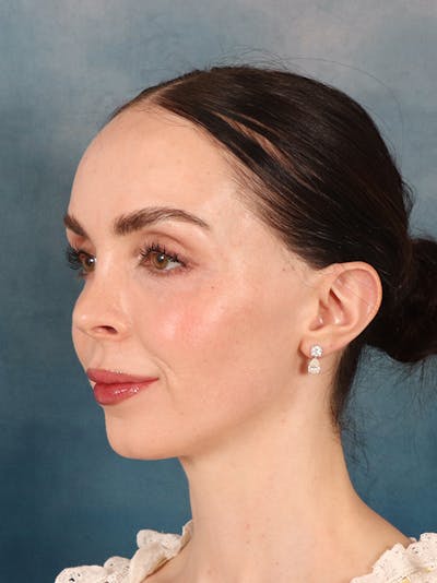 Rhinoplasty Before & After Gallery - Patient 61874293 - Image 4